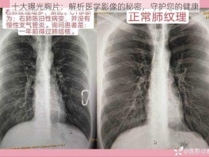 十大曝光胸片：解析医学影像的秘密，守护您的健康