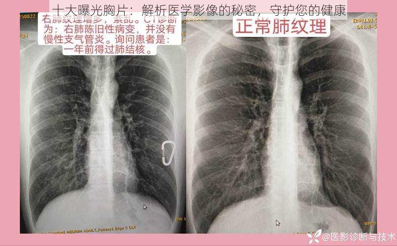 十大曝光胸片：解析医学影像的秘密，守护您的健康